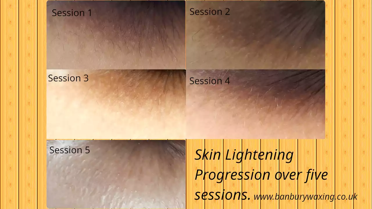 Anal bleaching skin lightening results over five sessions — Banbury Waxing, Oxfordshire