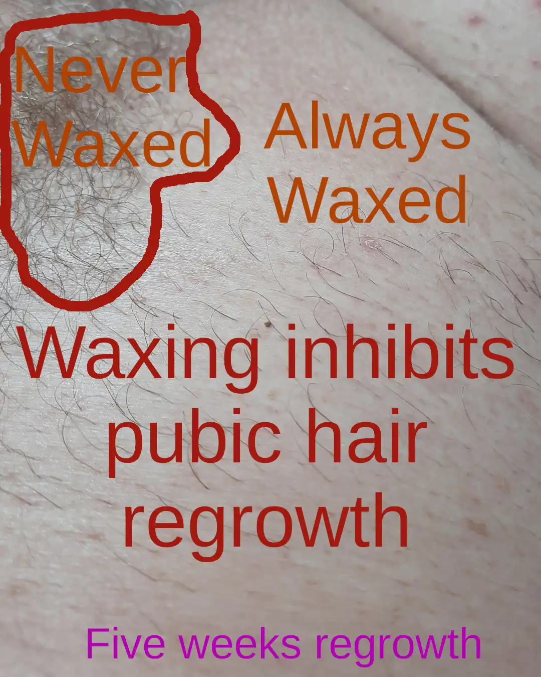 image demonstrating reduced hair growth after prolonged hollywood waxing