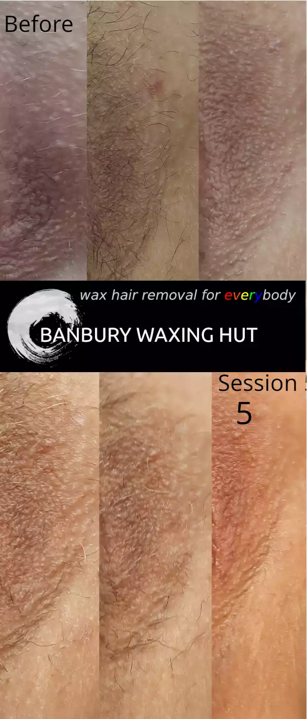 Intimate skin whitening before and after — progression over five sessions at Banbury Waxing