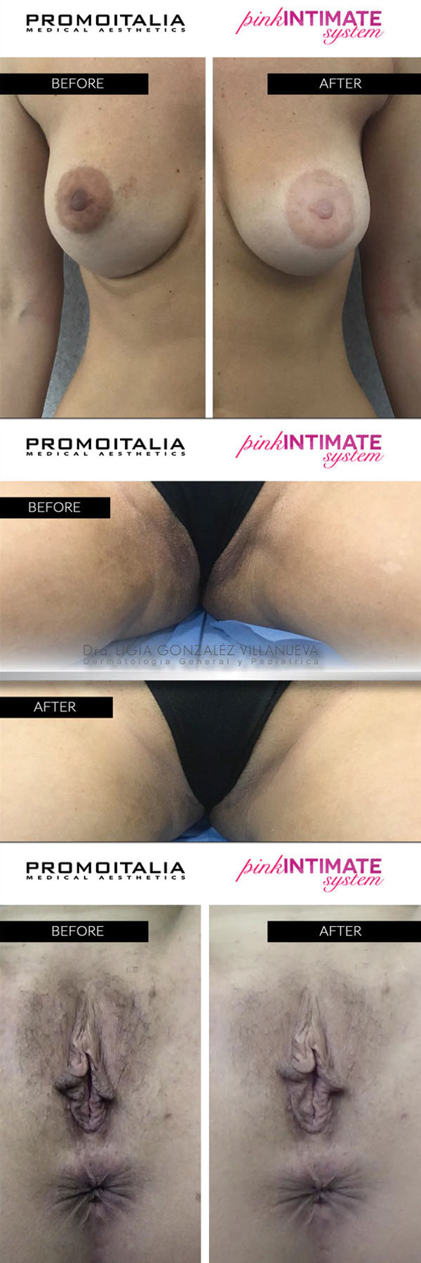 Vulva and areola skin lightening before and after — Promoitalia Pink Intimate System results